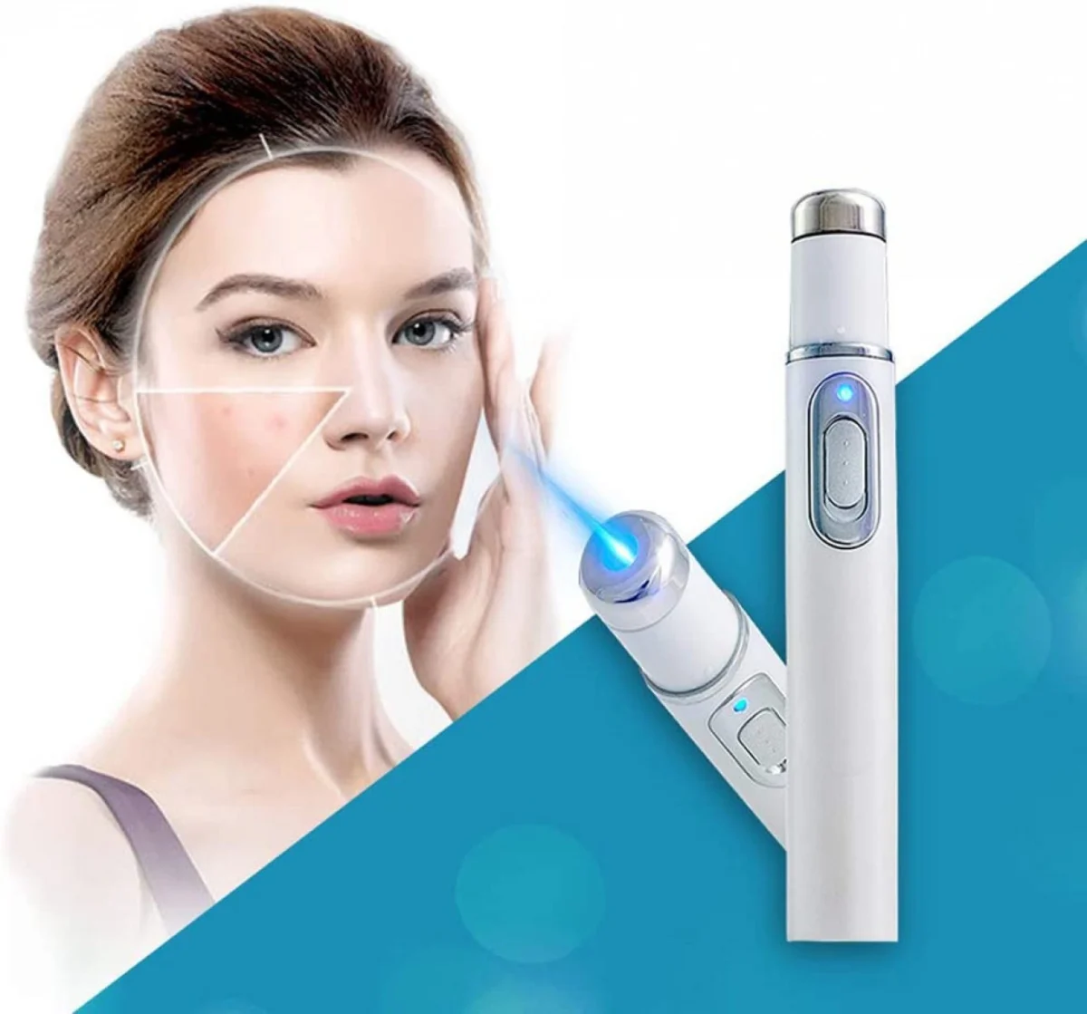 Στυλό Λέιζερ κατά της Ακμής και Θεραπεία του Δέρματος Blue Light Acne Pen KD-7910