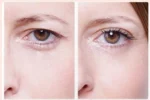 Αυτοκόλλητο Ανόρθωσης Βλεφάρου Eyelid Lift Strips 810 Τεμάχια