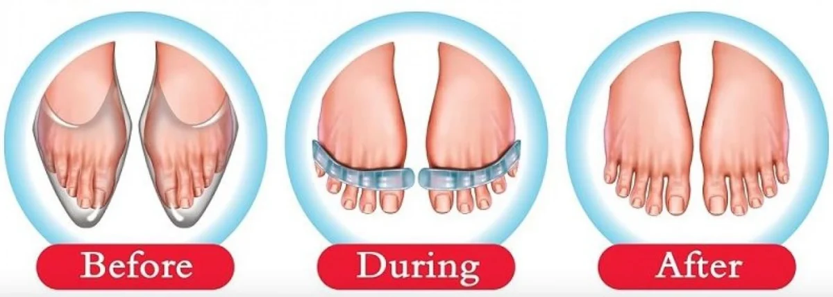 2 x Ορθοπεδικά Διαχωριστικά Gel Μασάζ Δακτύλων Flex-Feet
